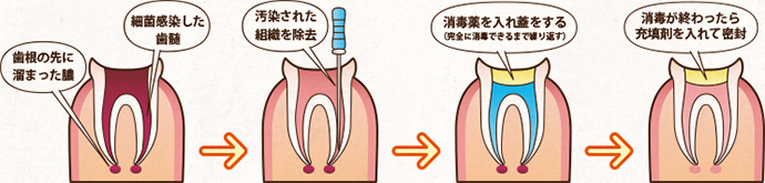 根管治療